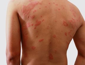 Eczema and Dermatitis: Types, Causes, and Management