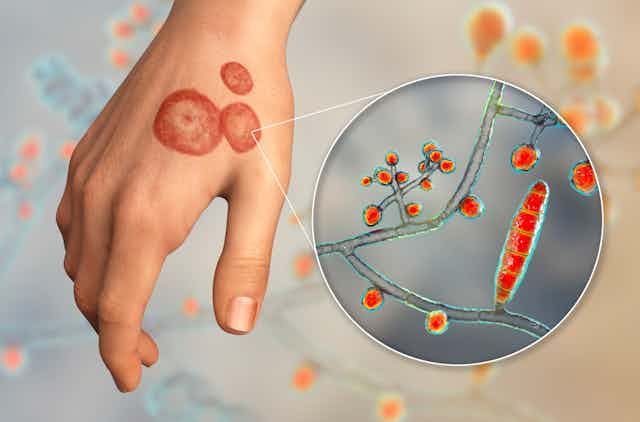 Infective Skin Diseases: Causes, Symptoms, and Treatments