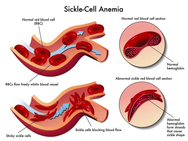 Sickle Cell Anemia: Causes, Complications, and Management