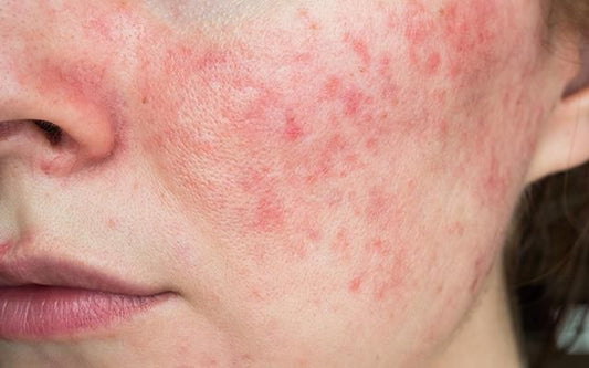 Acne Vulgaris: Causes, Treatment, and Management
